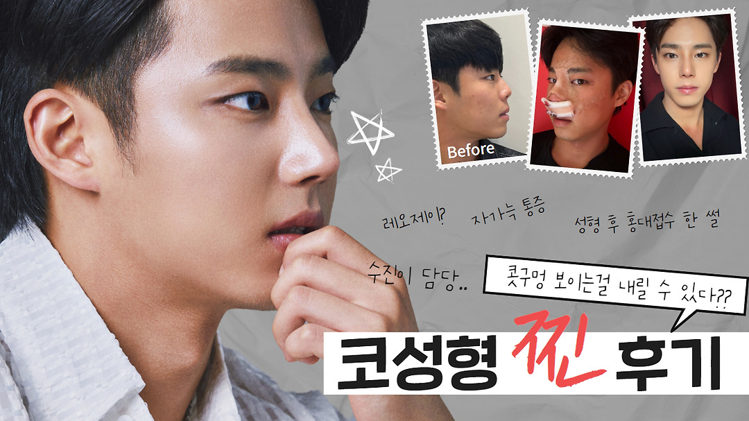 | 들창코, 들린코 싹!! 내렸습니다....남자코성형 | 들창코 후기 - kakaoTV 코만 했는데 상남자 이미지로 대변신!  | 들창코, 들린코 싹!!... 