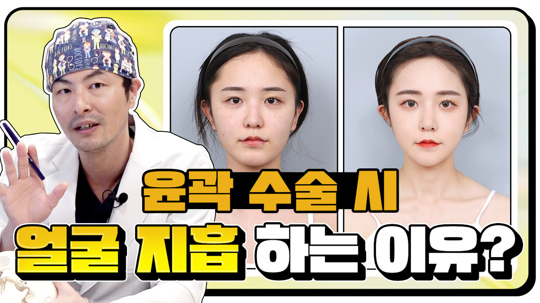 l 윤곽3종, 얼굴 지흡 후기 l 디에이성형외과 - kakaoTV 윤곽 수술 시... 얼굴 지방흡입 하는 이유는? l 윤곽3종, 얼굴 지흡 후기 l 디에이성형외과