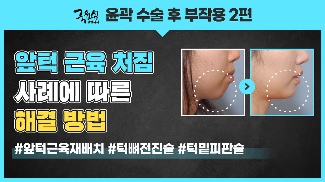 윤곽수술 부작용! 해결할 수 있는 3가지 방법! - kakaoTV 윤곽수술 부작용! 해결할 수 있는 3가지 방법!