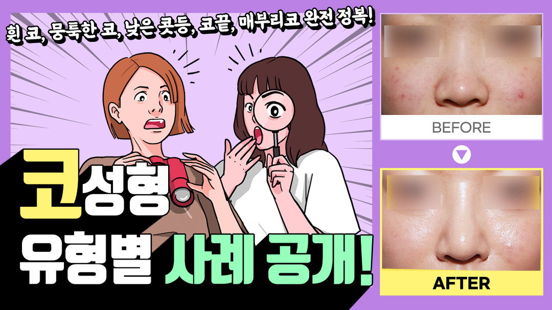 수원코수술(수원코성형) 전후 유형별 사례 대공개!│수원시청역성형외과│이상호성형외과 - kakaoTV 수원코수술(수원코성형) 전후 유형별 사례... 
