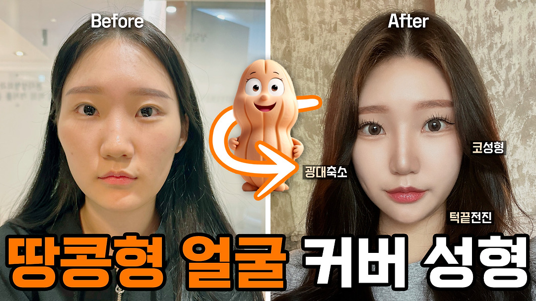 평평하고 울퉁불퉁한 얼굴.. 한방에 해결?! | 코수술 + 광대축소 + 턱끝수술 5개월차 리얼후기 - kakaoTV 평평하고... 