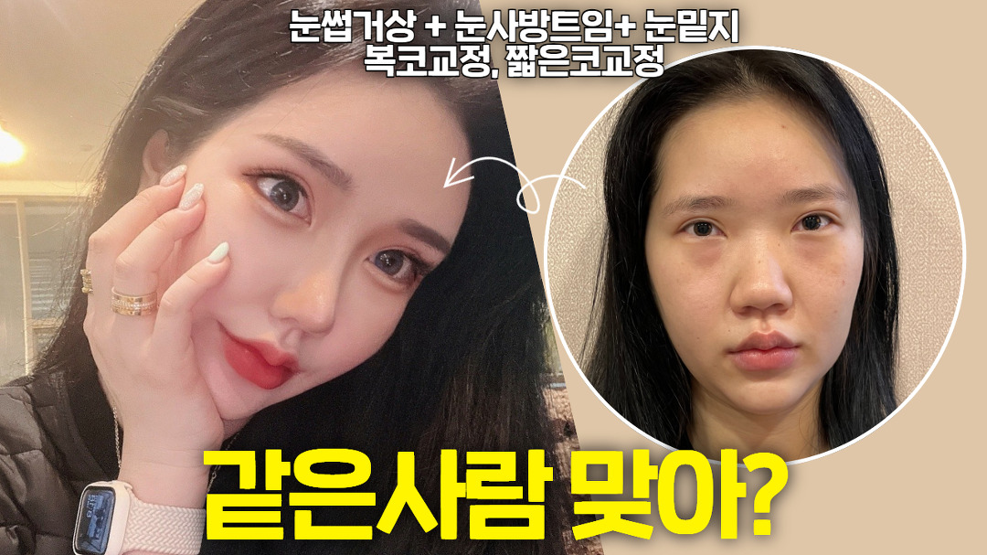 윗트,뒷트,밑트 하면 이렇게 눈이 커질 수 있습니다. | 성형 전후 레전드 후기 - kakaoTV 윗트,뒷트,밑트 하면 이렇게 눈이 커질 수 있습니다.... 