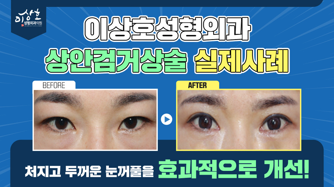 실제사례로 알아보는 수술 효과! | 수원 이상호성형외과 - kakaoTV 상안검거상술 실제사례로 알아보는 수술 효과! | 수원 이상호성형외과