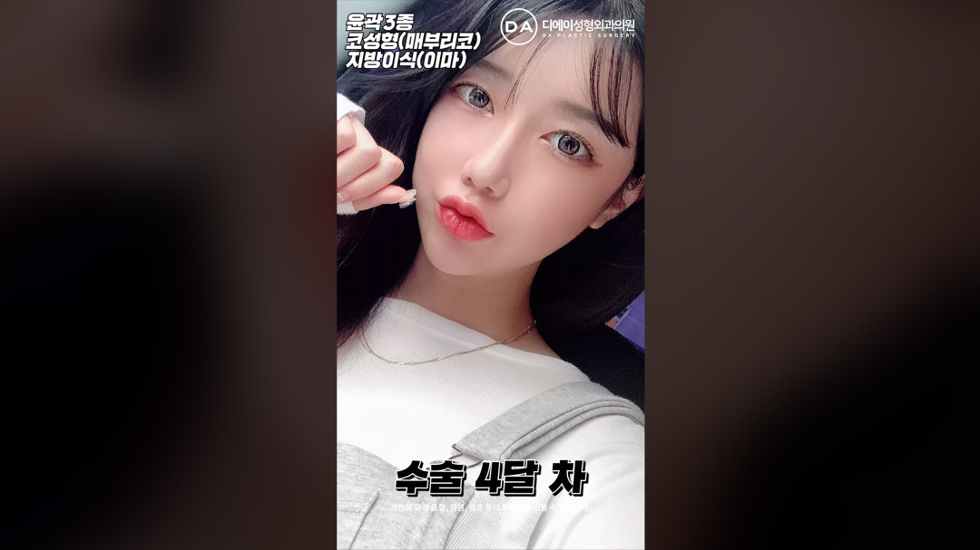 후기(매부리코)+이마 지방이식 효과 l 디에이성형외과 - kakaoTV 윤곽3종전후+코성형 후기(매부리코)+이마 지방이식 효과 l 디에이성형외과